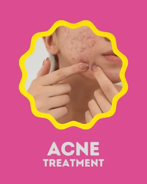 Acne Treatment